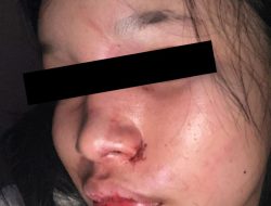 Viral ! Gadis Batam Ungkap Penganiayaan Brutal dari Mantan Kekasih di Instagram, Polisi Buru Pelaku